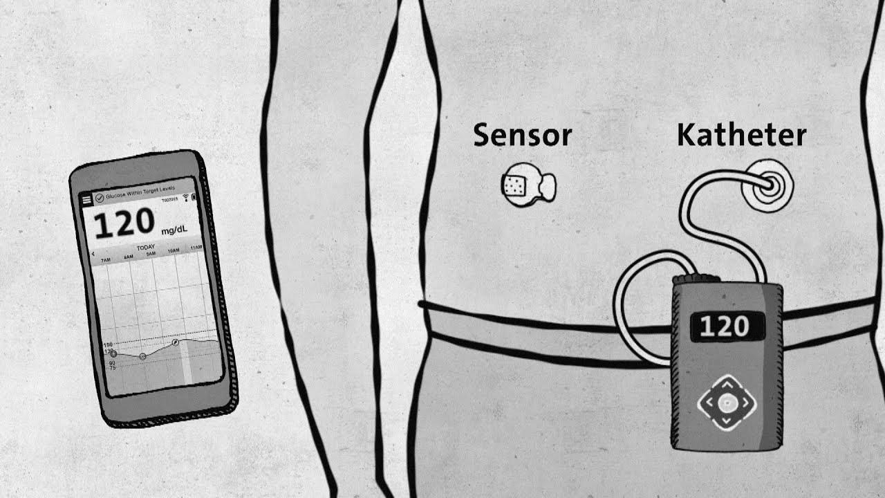 Kind 1 diabetes – trendy technology with out approval – good to know